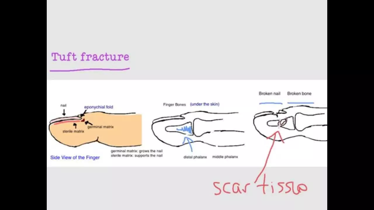 BoneTalks - FingerTip and Nailbed Injuries (Tuft Fracture)
