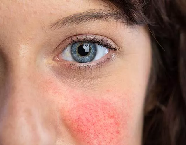 Cutaneous-Lupus Cutaneous Lupus