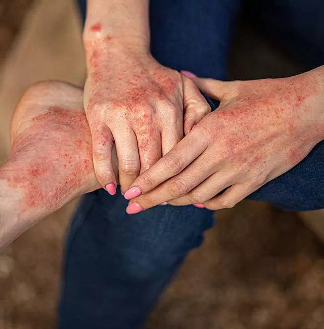 eczema-clincinal-research