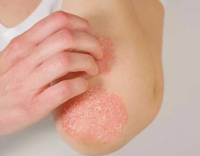 eczema-clinical-trial Eczema Clinical Trial