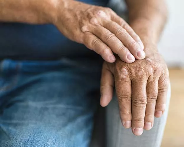 psoriatic-arthritis-clinical-study psoriatic arthritis clinical study