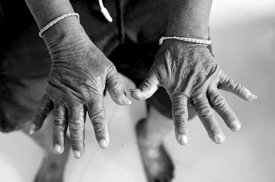 clinical-study-scleroderma Scleroderma Clinical Study