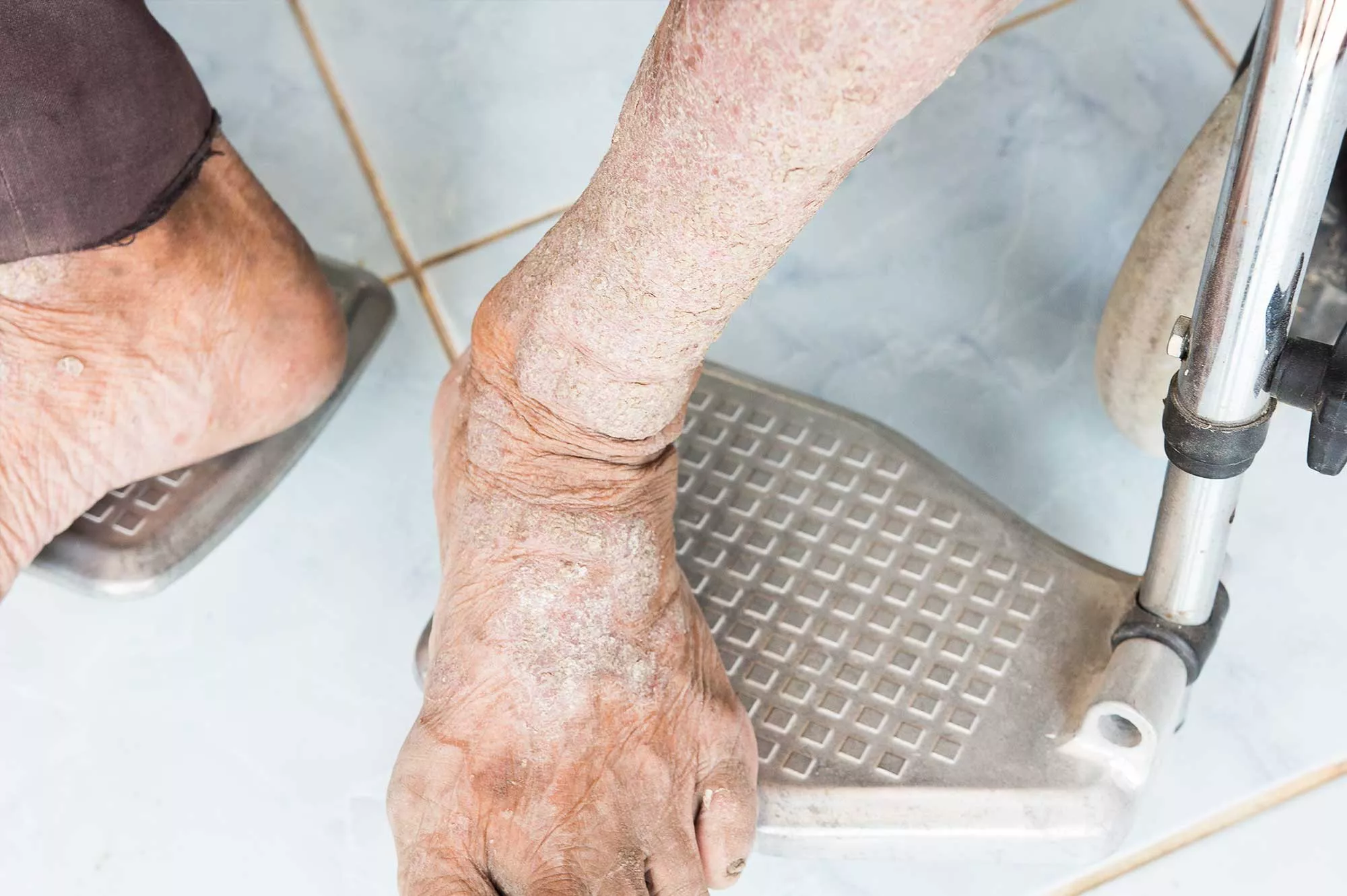 Systemic Sclerosis in the feet of a patient during a clinical study