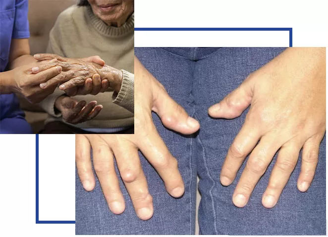 rheumatoid-arthritis-ra rheumatoid arthritis