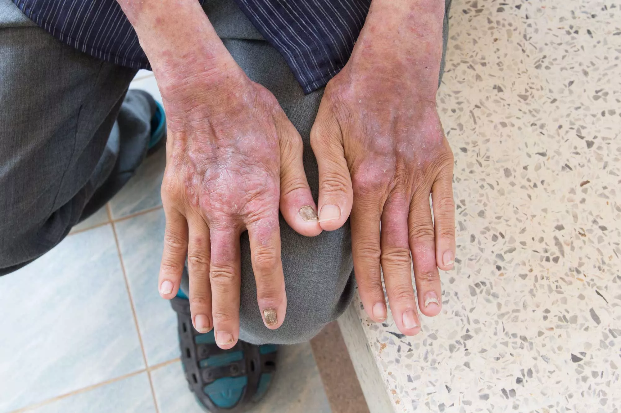 scleroderma-in-hands Patient with Scleroderma, Systemic Sclerosis affecting the hands in a clinical trial
