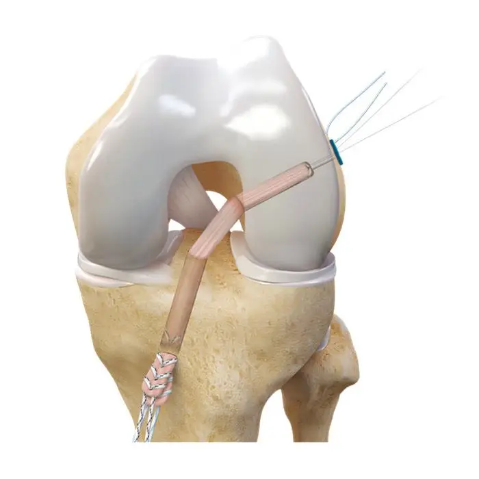 Buy Best Sport Medicine,Orthopaedics Suppliers,Suture Anchor
