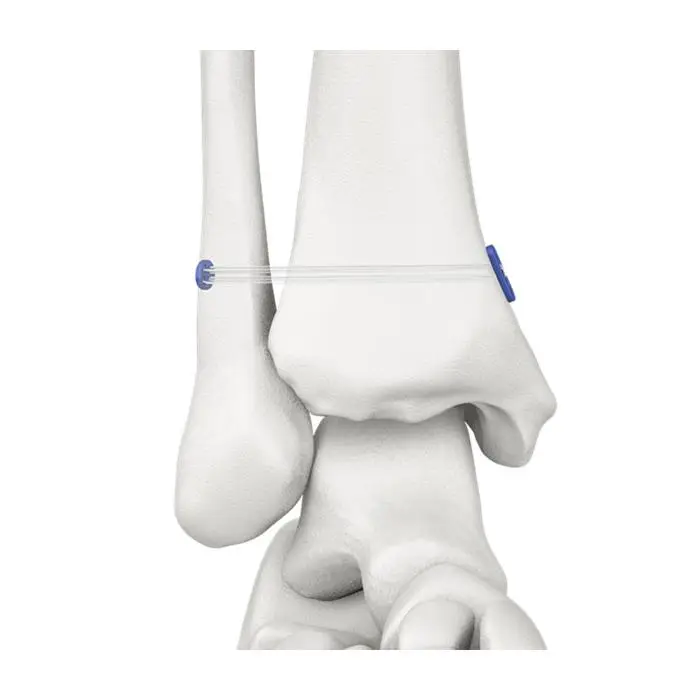 Buy Best Sport Medicine,Orthopaedics Suppliers,Suture Anchor
