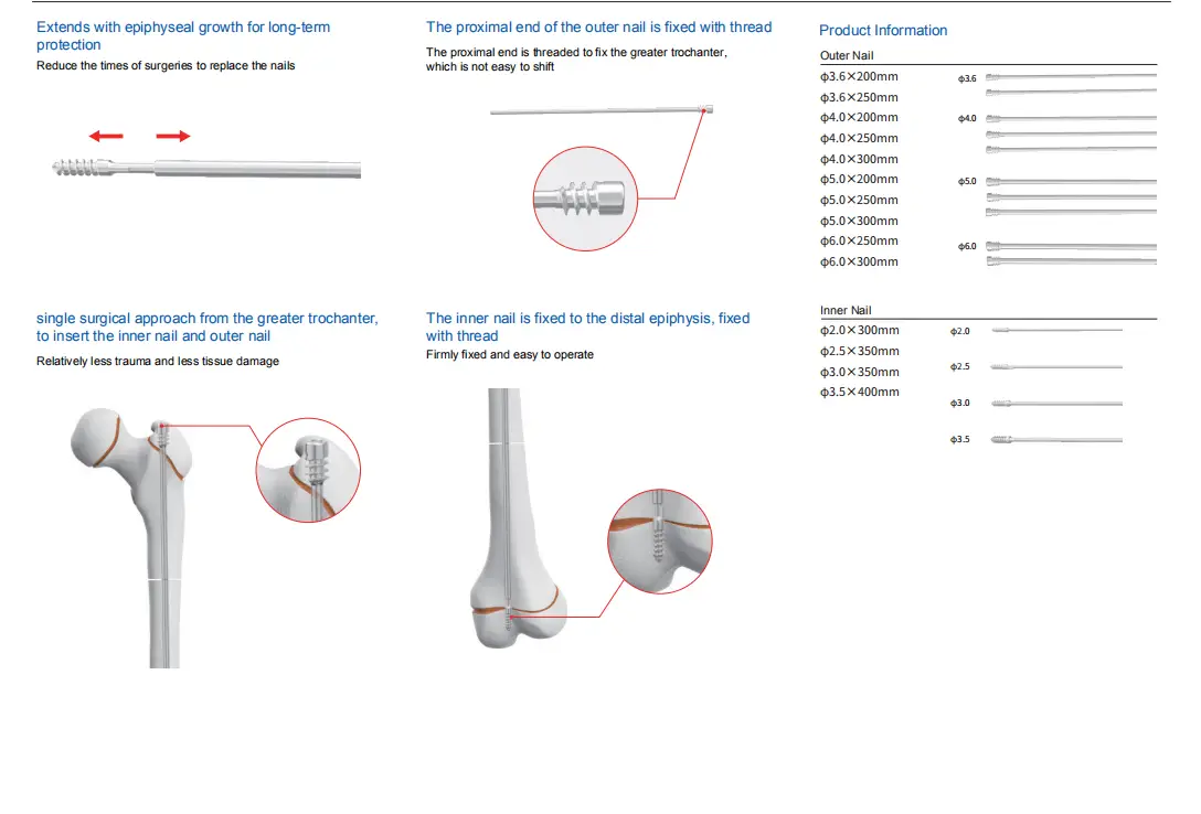SN Pediatric Slide Intramedullary Nail System SN Pediatric Slide Intramedullary Nail System