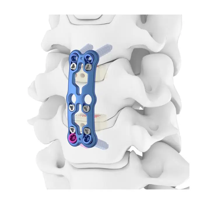 Spinal Surgery Implants,Cervical Spine Locking Plate,Spinal