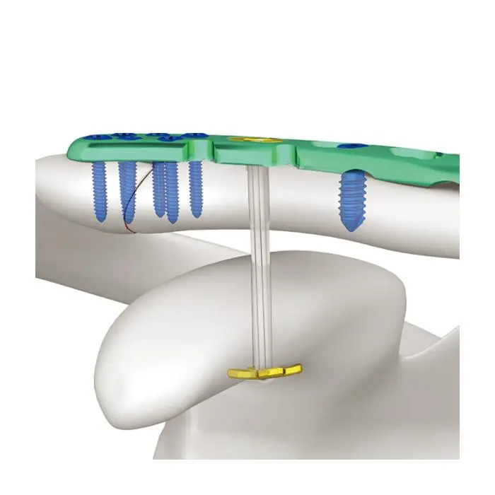 Buy Best Sport Medicine,Orthopaedics Suppliers,Suture Anchor