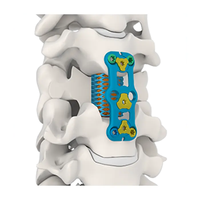 Solutions For Anterior Cervical Spine | Spine Implants