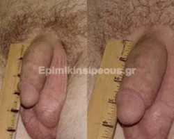 Φαλλοπλαστική 6 Φαλλοπλαστική 3