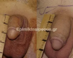 Φαλλοπλαστική 5 Φαλλοπλαστική 2