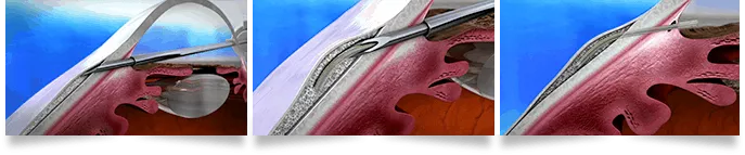 Xen Gel Stent Florida Eye Specialists