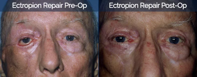 Ectropion Repair Before & After 1
