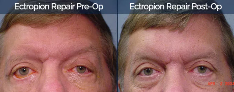 Ectropion Repair Before & After 2