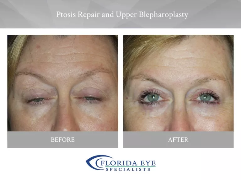 Ptosis Repair Upper Blepharoplasty Florida Eye Specialists