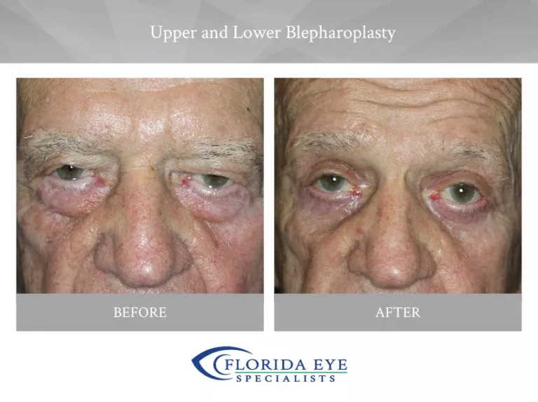 Upper and Lower Blepharoplasty