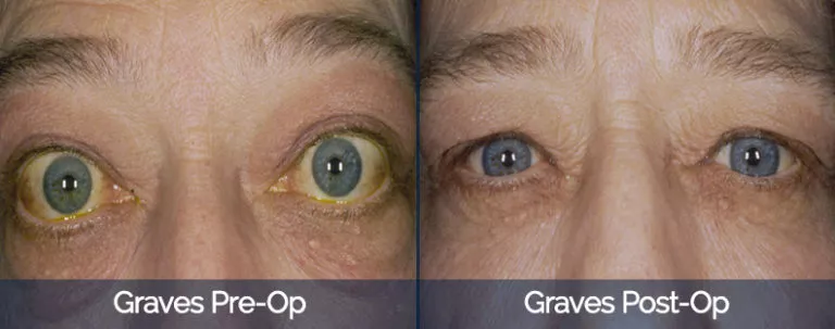 Graves’ Disease Before & After 2