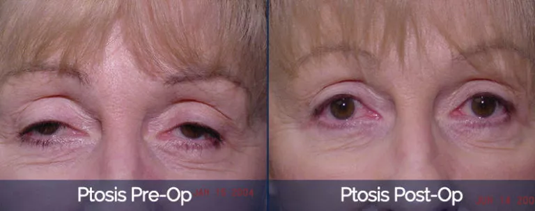 Ptosis Before & After 1