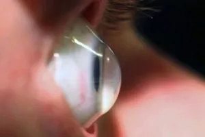 Scleral Contact Lenses