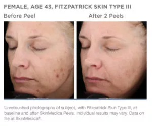 Skinmedica Peel Before and After