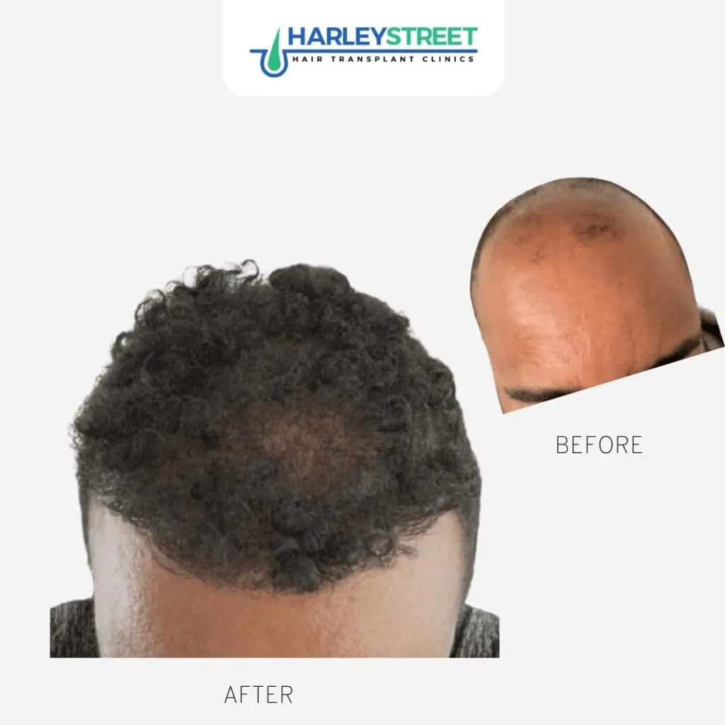 Calvin Before & Afters