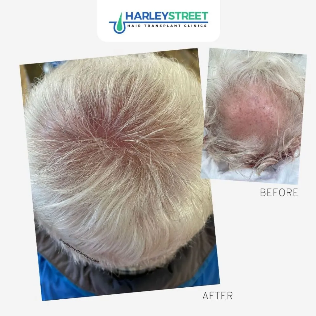 Free Consultation Harley Street Ht Clinics before and after crown older man