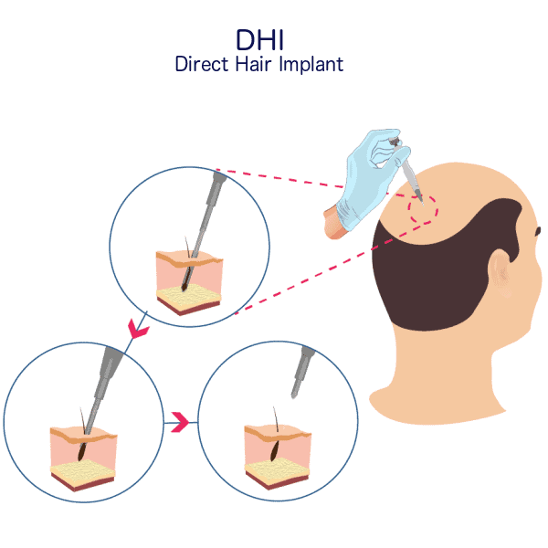 DHI Method 1 DHI-Hair-Transplant-Procedure-min