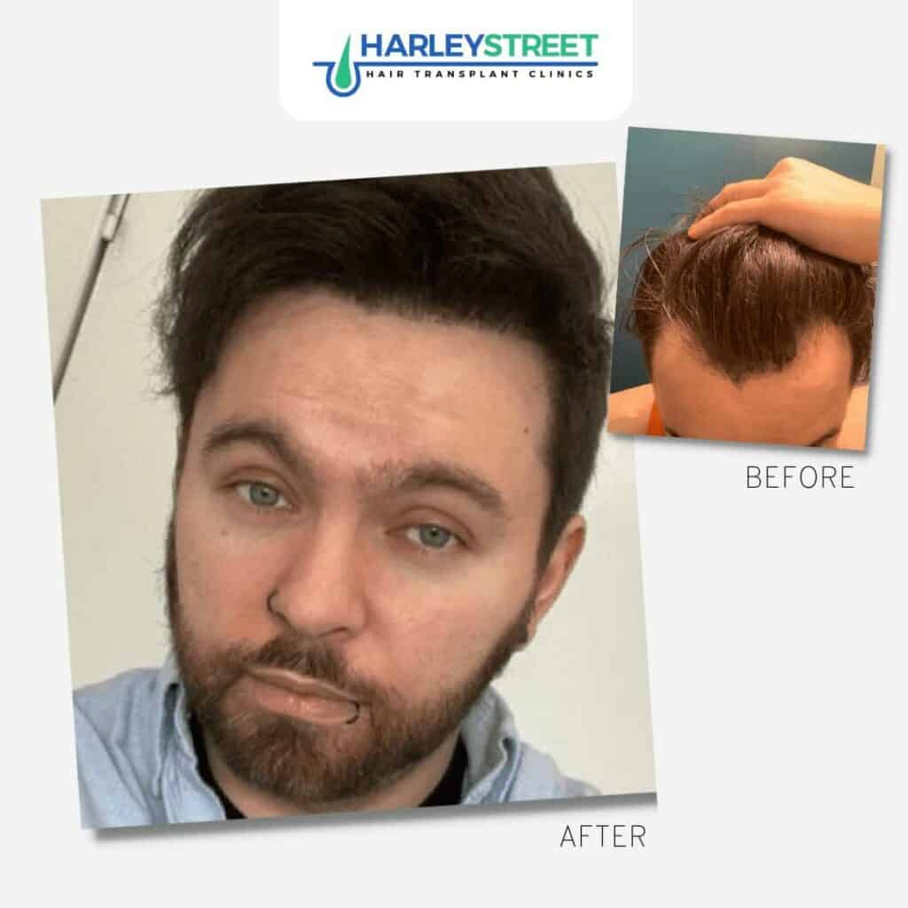 Free Consultation 9 FUE-Before-and-After-3