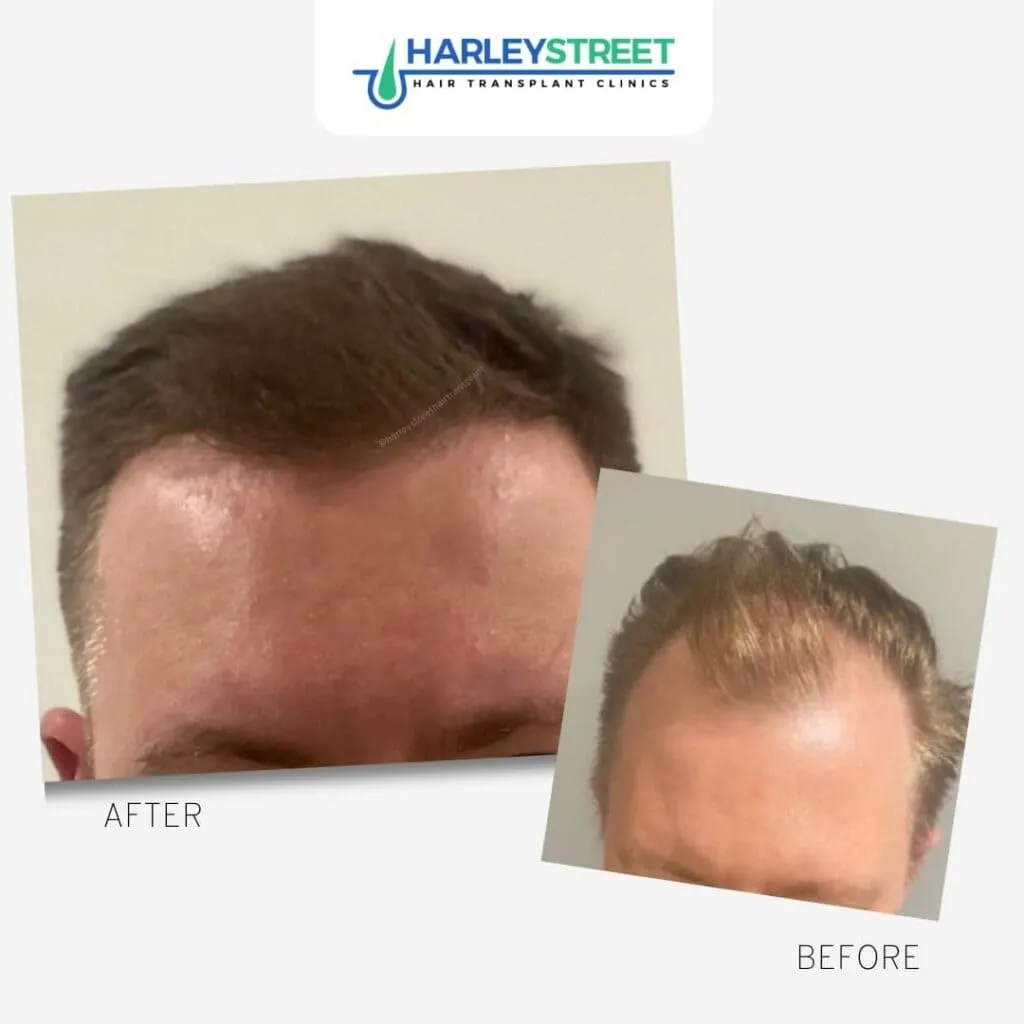 Hair Transplant Before & After Results 11 Harley St before and after front hairline and temples