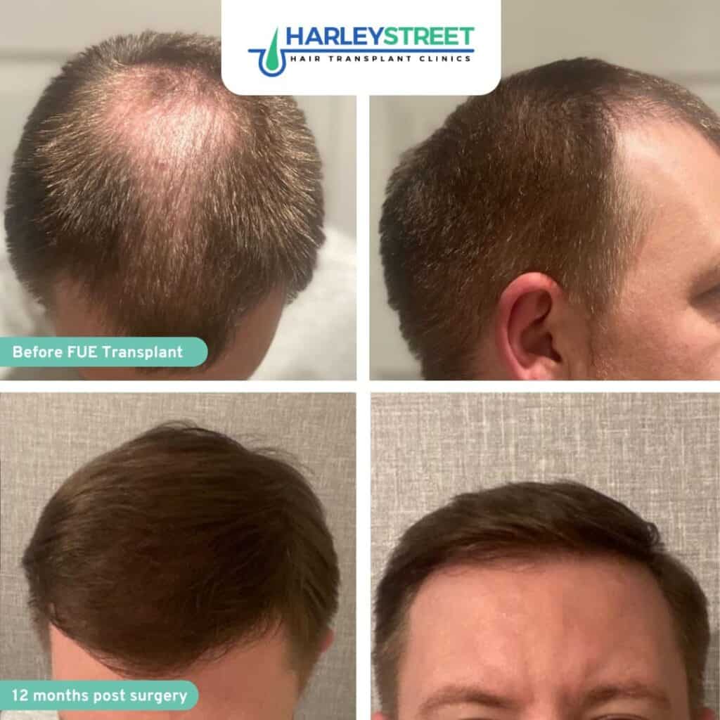 Hair Transplant Before & After Results 8 Harley Street HT Clinics crown and hairline before and after