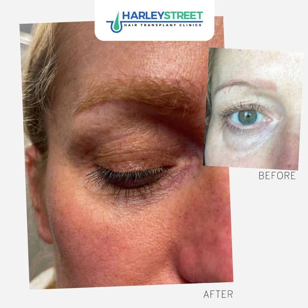 Eyebrow Transplant 3 Harley Street Hair Transplant Clinics female patient eyebrow transplant before and after