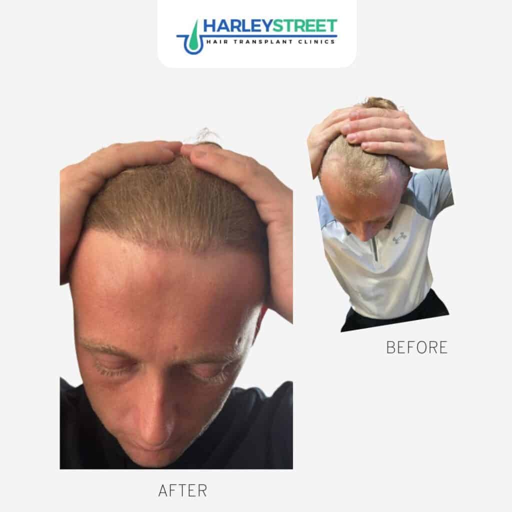 Hair Transplant Before & After Results 7 Jack Before & Afters