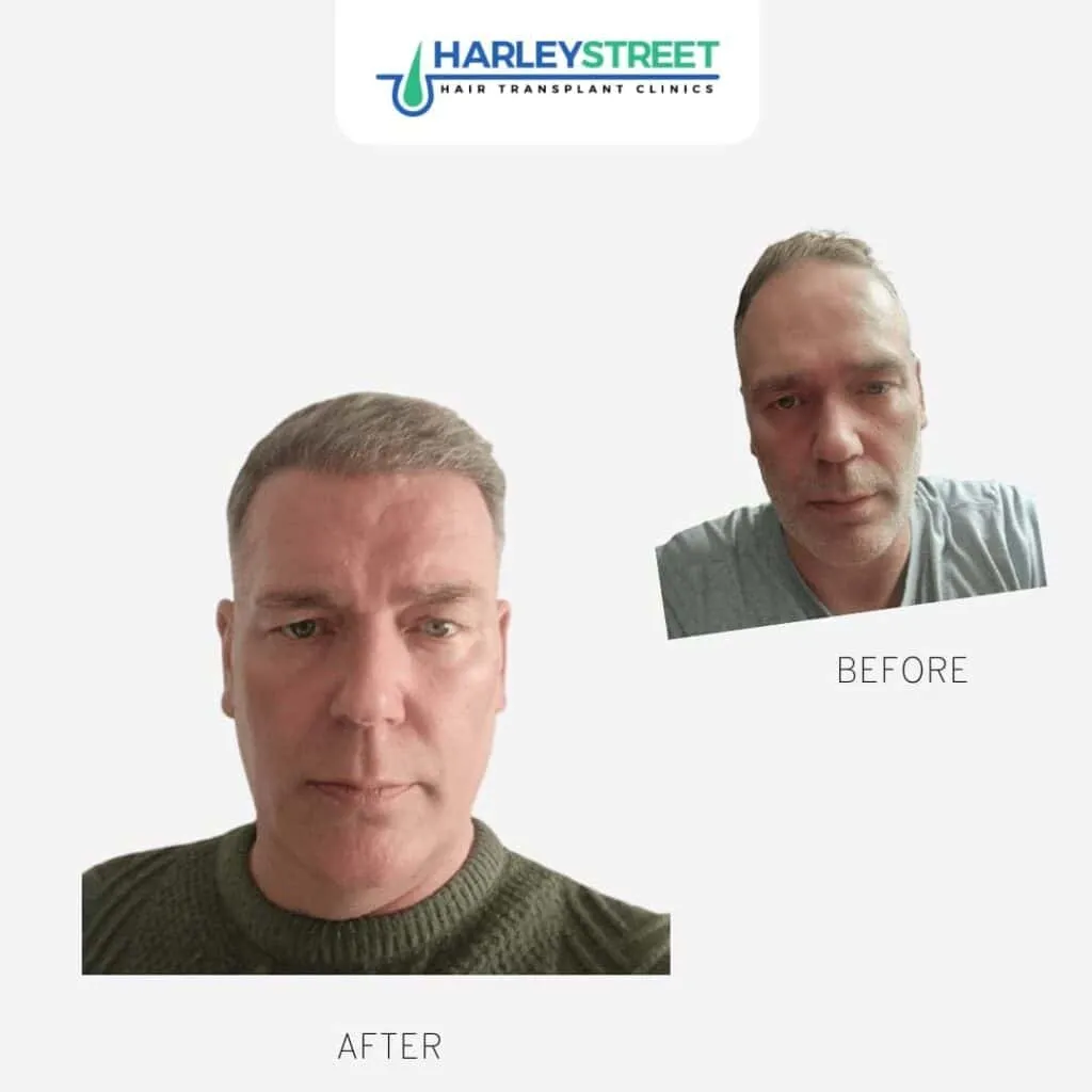 Hair Transplant Before & After Results 6 M-Warburton-Before-Afters
