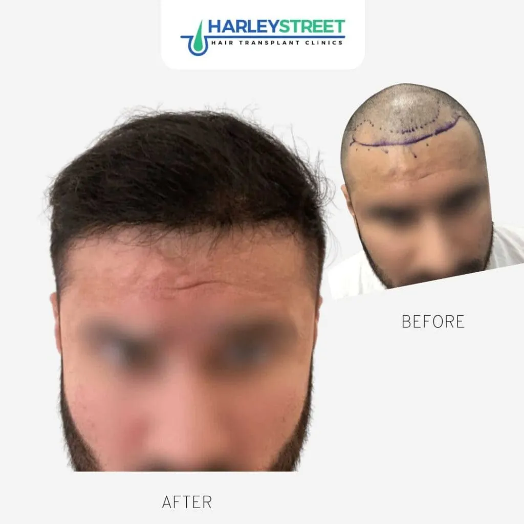 Hair Transplant Before & After Results 4 Shreyas Before & Afters