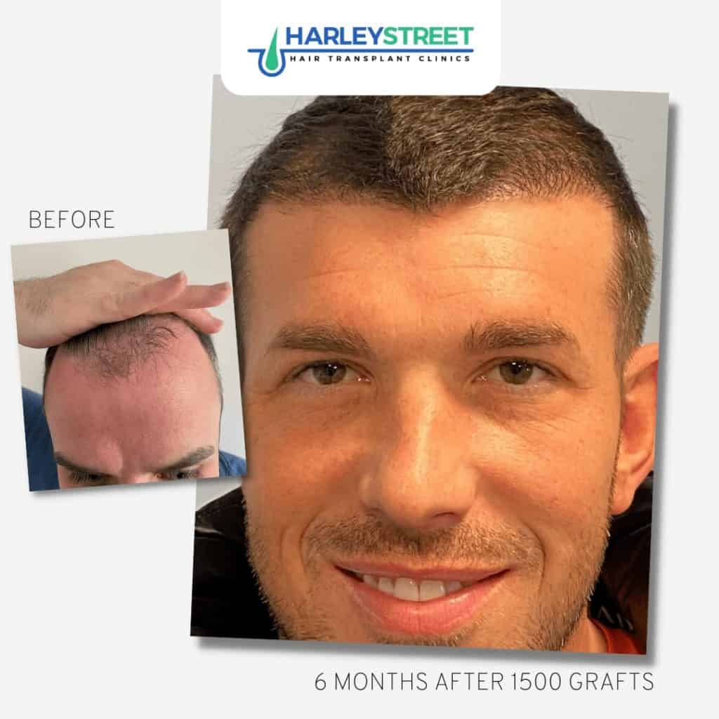 Hairline Hair Transplant 4 FUE-Before-and-After-5