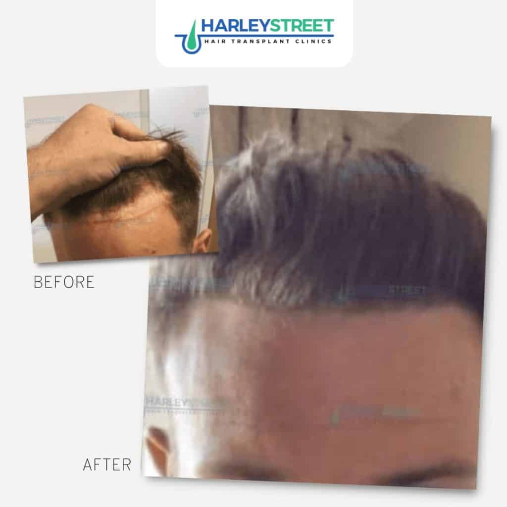 Hairline Hair Transplant 2 FUE-Before-and-After-8