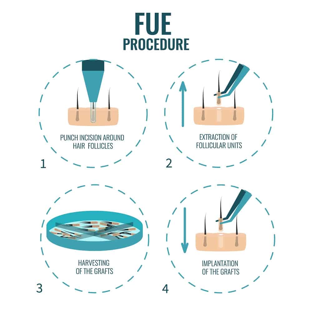 Hair Transplant 3 FUE stages treatment