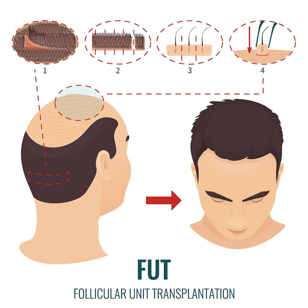 Hair Transplant 4 FUT stages treatment