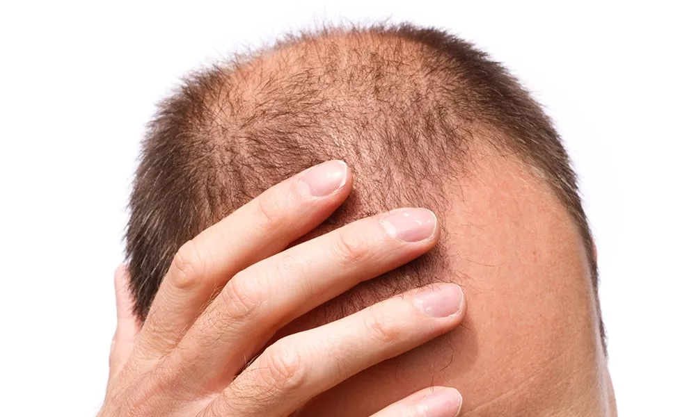 Male Pattern Baldness 2 Male Pattern Baldness 1