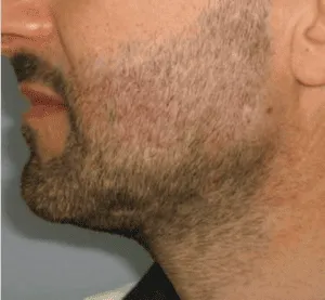 Beard Transplant 3 Beard-Transplant-After