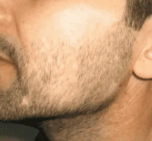 Beard Transplant 2 Beard-Transplant-Before