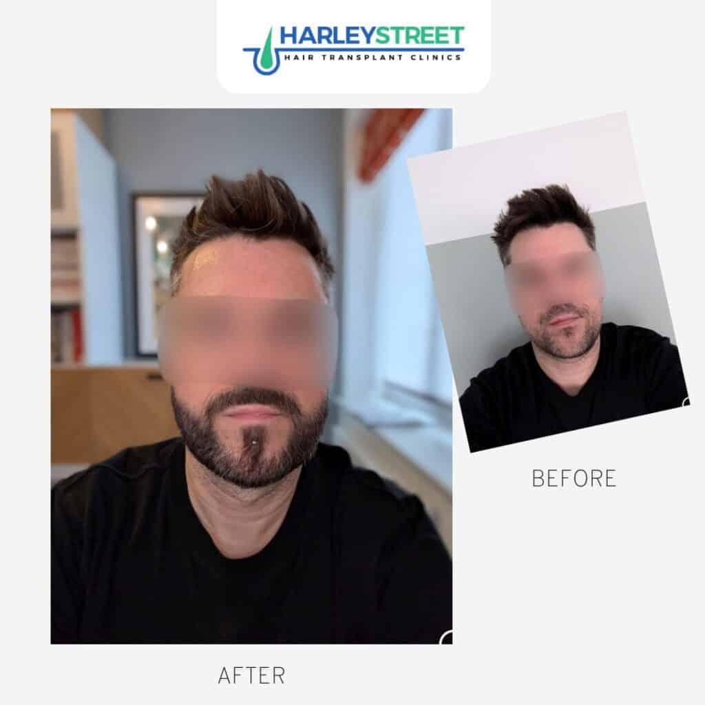 Beard Transplant 1 Beard-transplant-before-and-after-Paul-1024x1024