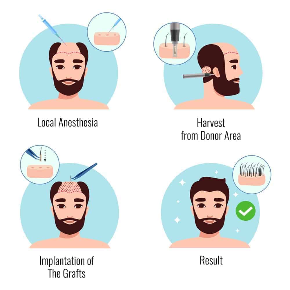 Hair Transplant 1 Hair-Transplant-Procedure-and-process-min