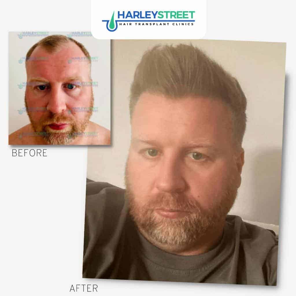 Before and After Gallery 16 Harley-Street-Hair-Transplant-Clinics-patient-Aaron-before-and-after-1