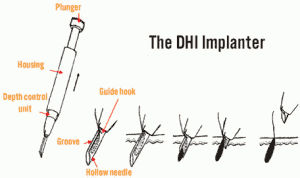 DHI Method 2 dhi-hair-transplant-method-tool-300x178
