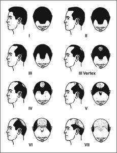 Male Pattern Baldness 1 male-pattern-baldness-or-androgenetic-alopecia-230x300