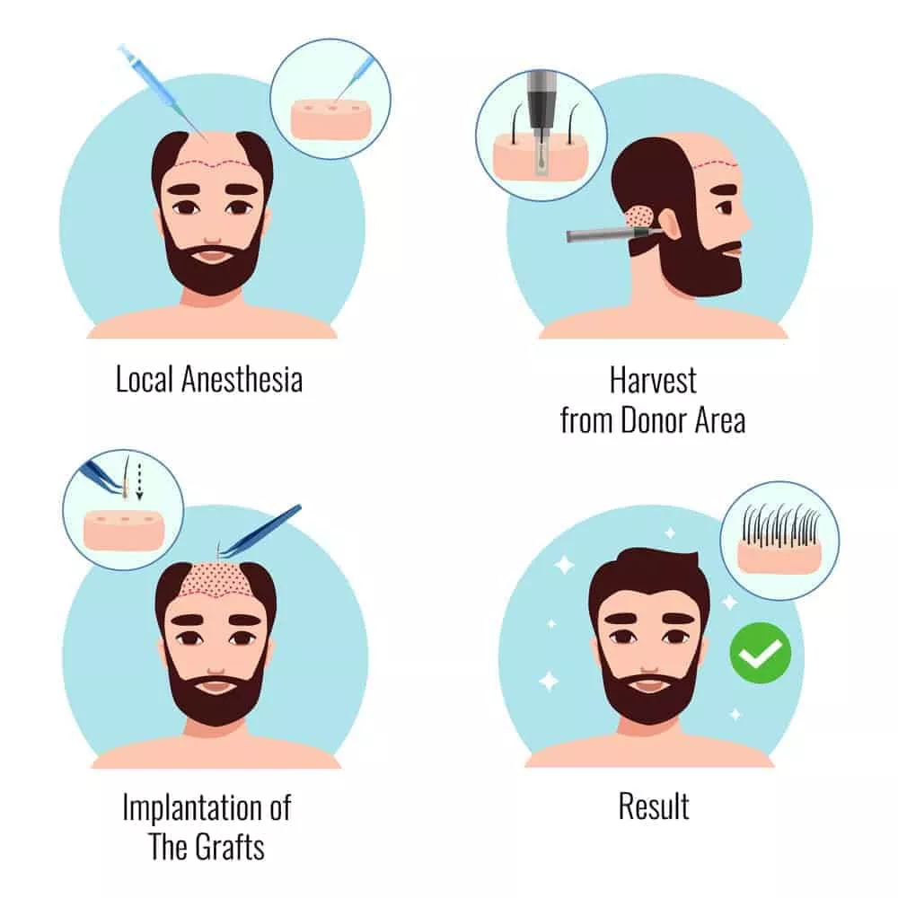 Home 26 Hair-Transplant-Procedure-and-process-min