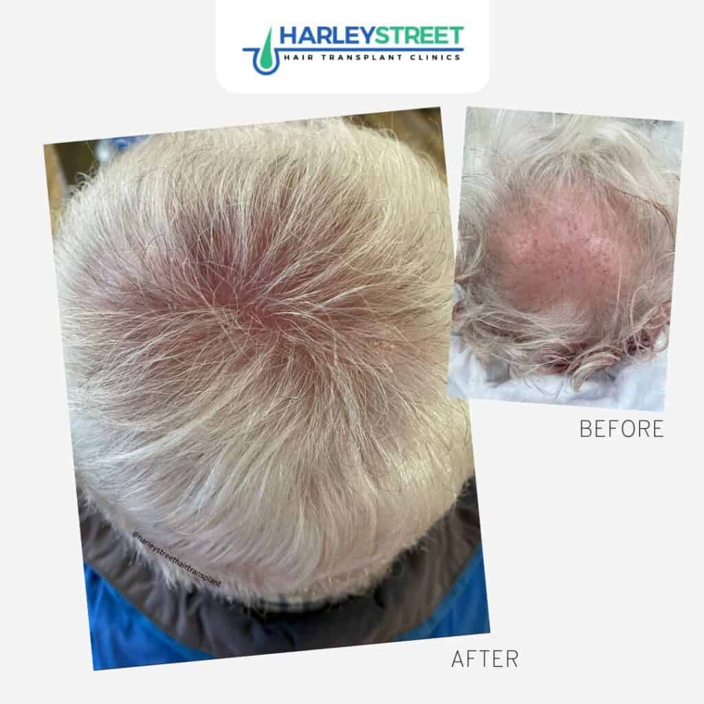 Home 14 Harley Street Ht Clinics before and after crown older man